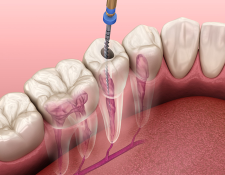 ENDODONTİ